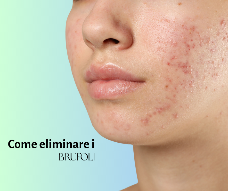 come eliminare i brufoli woowl